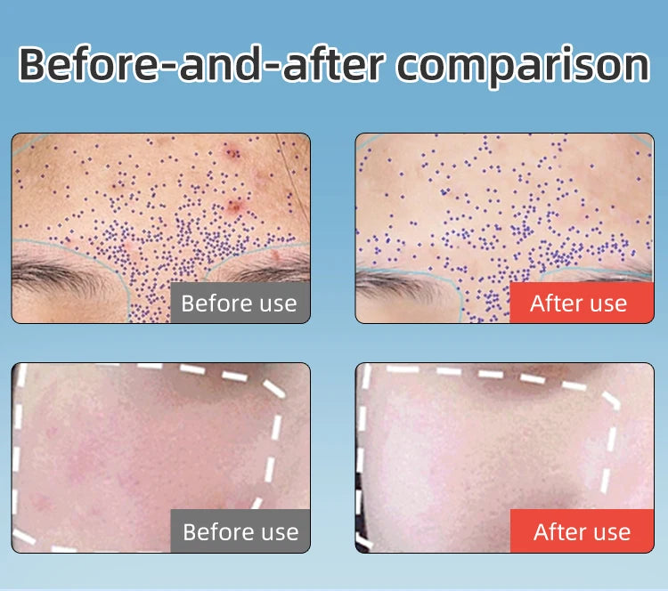 LED Face Mask and Red Light Therapy Device for Skin Rejuvenation