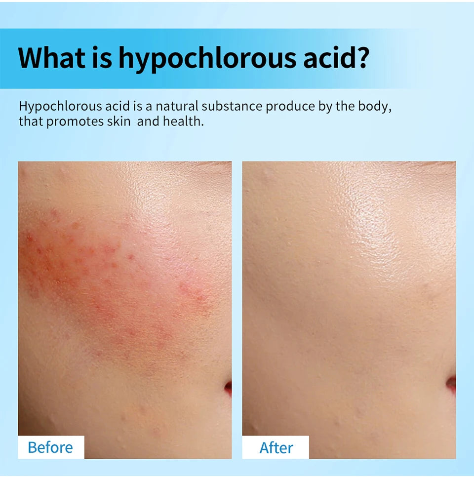 Hypochlorous Acid Facial Spray Skin Toner for Acne and Redness